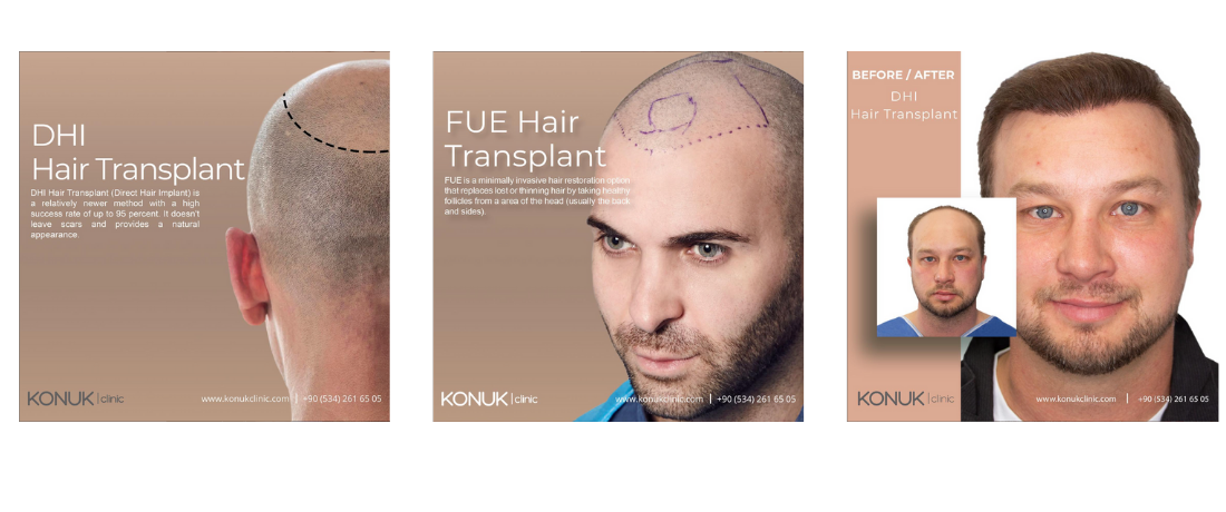 Unlock the Secret of DHI Hair Transplant - Stunning Before and After Transformations Revealed!