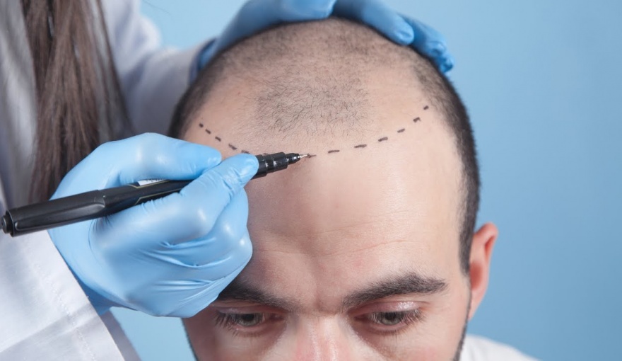 Navigating the Sapphire FUE Hair Transplant Experience in Turkey: What to Expect